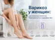 Варикоз у женщин: гормоны, беременность и лечение вен